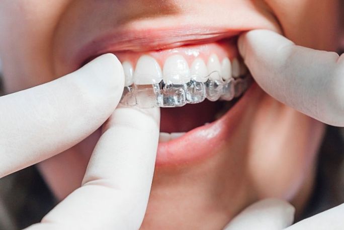 https://denticare.bold-themes.com/oscar/wp-content/uploads/sites/15/2020/01/invisalign.jpg